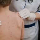 Chickenpox is a viral infection that mostly affects children, but you can get it at any age