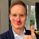 Dan Walker says he has no memory of the crash which left him bloody and bruised. Credit: Dan Walker