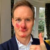 Dan Walker says he has no memory of the crash which left him bloody and bruised. Credit: Dan Walker