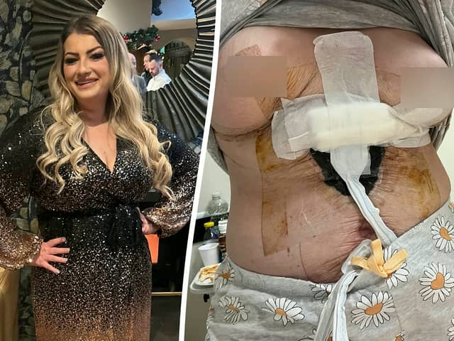 Sara Platt during happier times (L) and her right breast died and she contracted an anti-biotic resistant infection after a ’botched’ Turkish cosmetic surgery (R). (Sara Platt / SWNS)