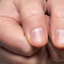 'Beau's lines' are transverse indents in the nail (Photo: Shutterstock)