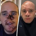 Ben Horne, who lost his nose when his dog ripped it off while trying to save him from a seizure has undergone ten reconstructive surgeries - using bones from his ribs.