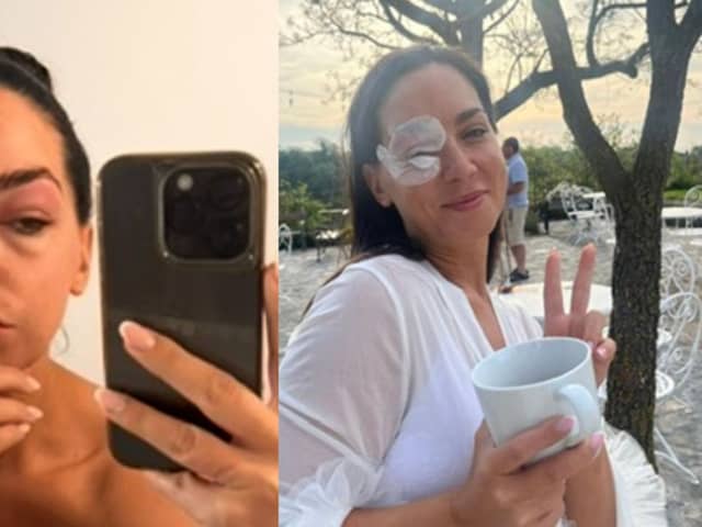 Northern Ireland woman woke up with a badly swollen eye on her wedding day after being bit by an insect.