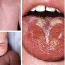 These are some of the scarlet fever symptoms to look out for. There have been 58 cases of the disease, caused by the Strep A bacteria, recorded in Sheffield since the end of September. Photo: NHS