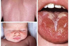 These are some of the scarlet fever symptoms to look out for. There have been 58 cases of the disease, caused by the Strep A bacteria, recorded in Sheffield since the end of September. Photo: NHS