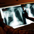 A doctor examines the x-rays of a tuberculosis (TB) patient at a clinic. (Photo by Spencer Platt/Getty Images)