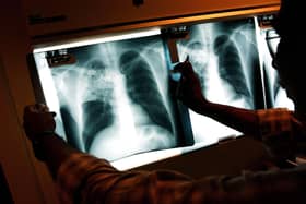 A doctor examines the x-rays of a tuberculosis (TB) patient at a clinic. (Photo by Spencer Platt/Getty Images)