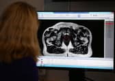 Dr Alison Tree, Consultant Clinical Oncologist at The Royal Marsden, treats patient diagnosed with prostate cancer